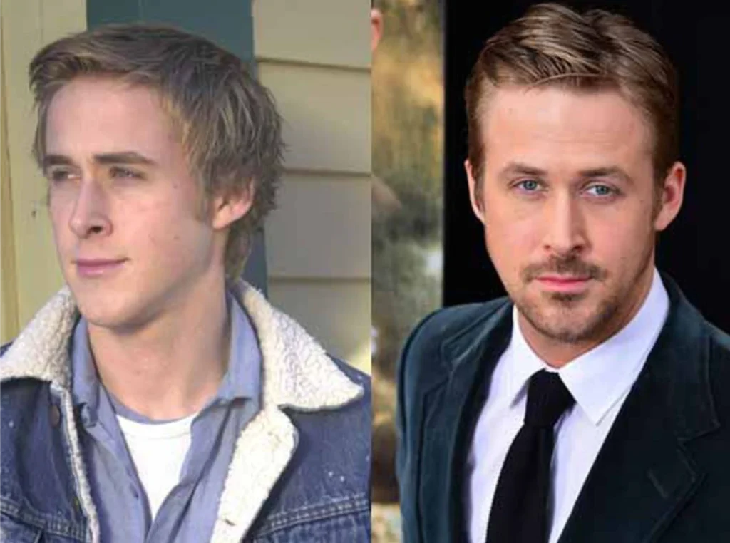 Botox is a popular cosmetic procedure that is used to reduce the appearance of wrinkles and fine lines. Some people have speculated that Ryan Gosling may have had Botox injections to keep his face looking youthful.