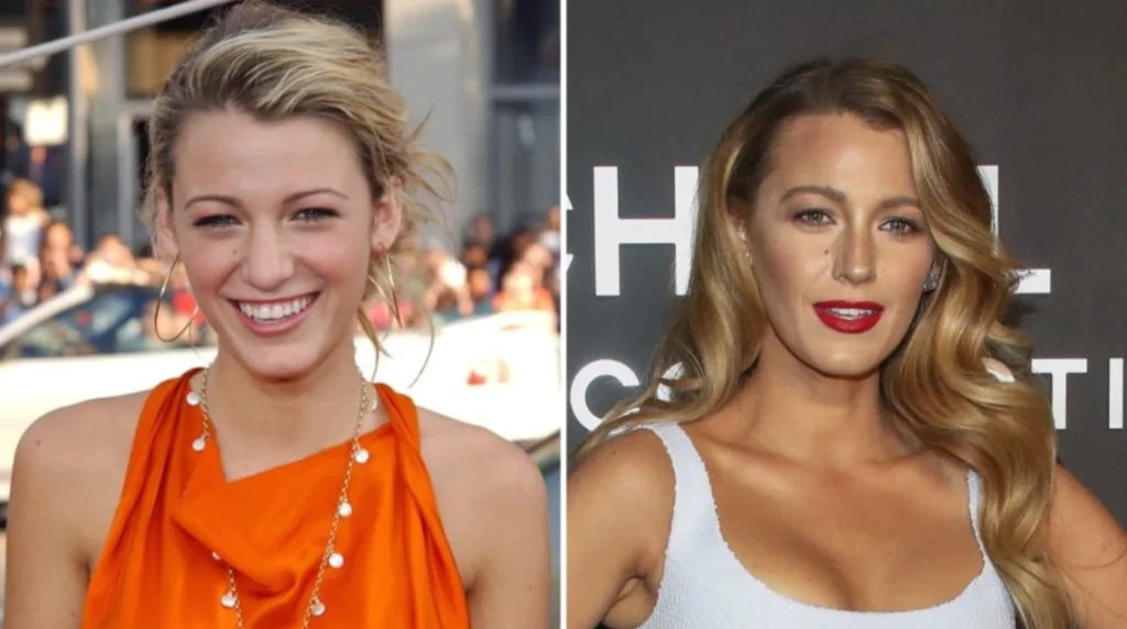 blake lively before and after nose job