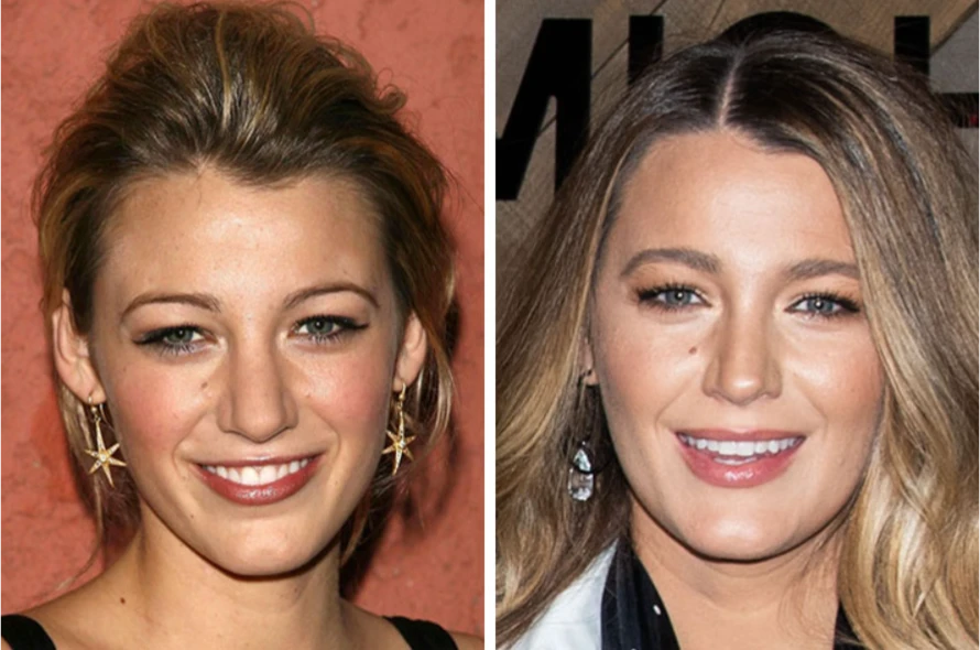Comparison photos of Blake Lively before and after clearly demonstrate that the nose has become more elegant and thinner. The price of a nose job (rhinoplasty surgery) reportedly ranges from $3,000 to $15,000.