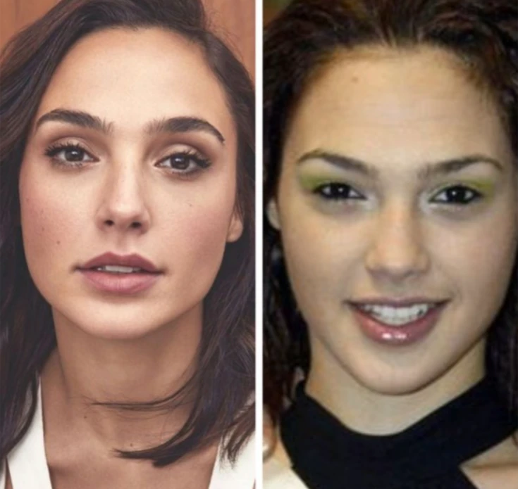 Did Gal Gadot Have Plastic Surgery? Before and After