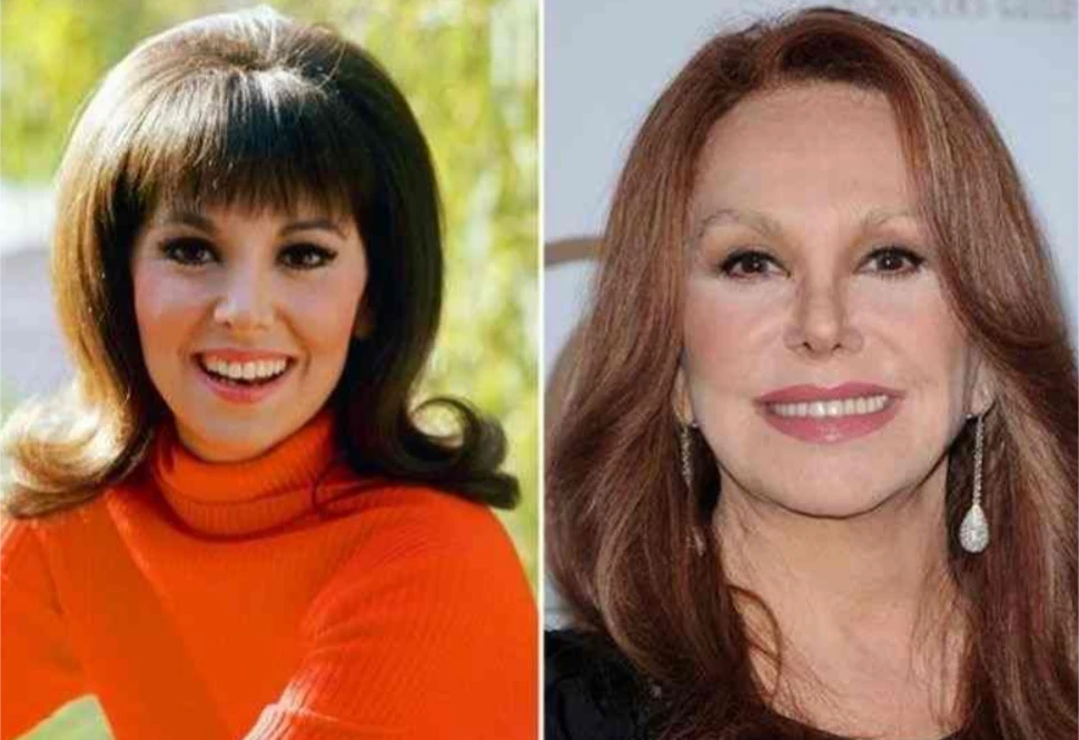 There have been speculations about Marlo Thomas undergoing plastic surgery. Some of the treatments fans talked about were rhinoplasty, brow lift, and facelift. The first change came on the nose like many actresses would go for. Now plastic surgery experts believe that she has tried most of the treatments such as botox injections, eyebrow lift, facial fillers and neck fillers.