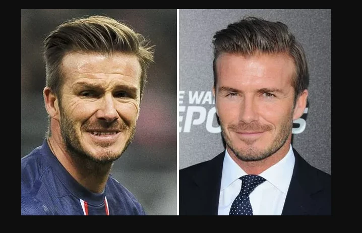 David Beckham Plastic Surgery 2