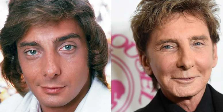 Has Barry Manilow Had Plastic Surgery?