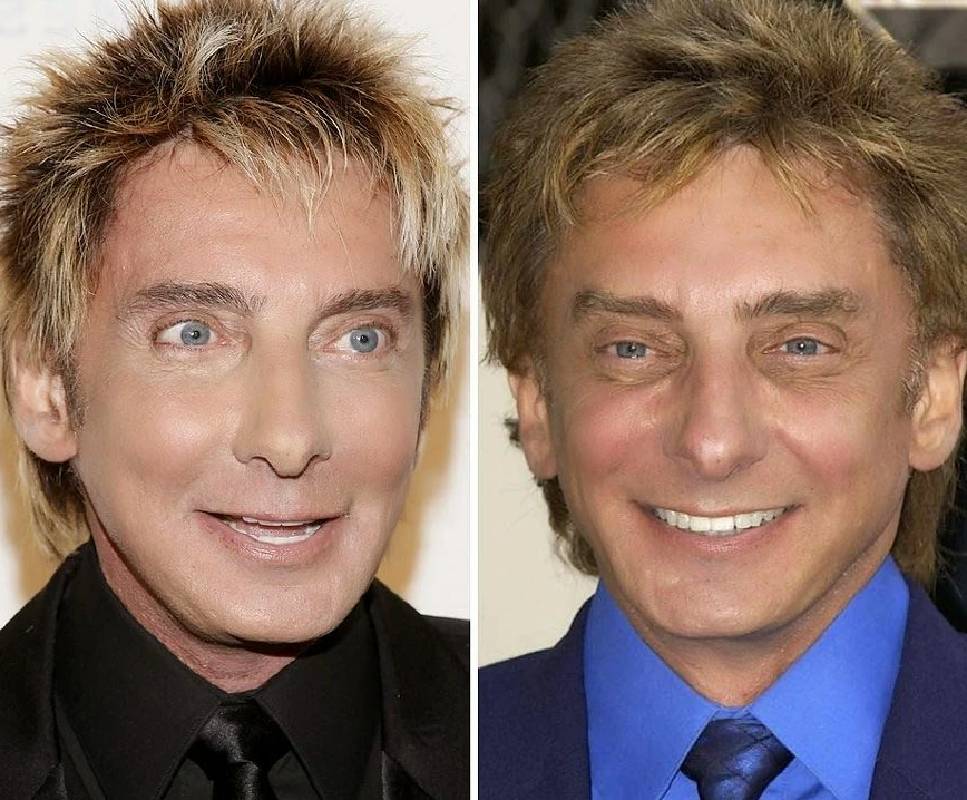 Has Barry Manilow Had Plastic Surgery