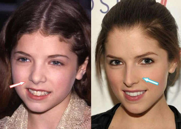 Anna Kendrick Plastic Surgery: Did She Really Go Under the Knife?