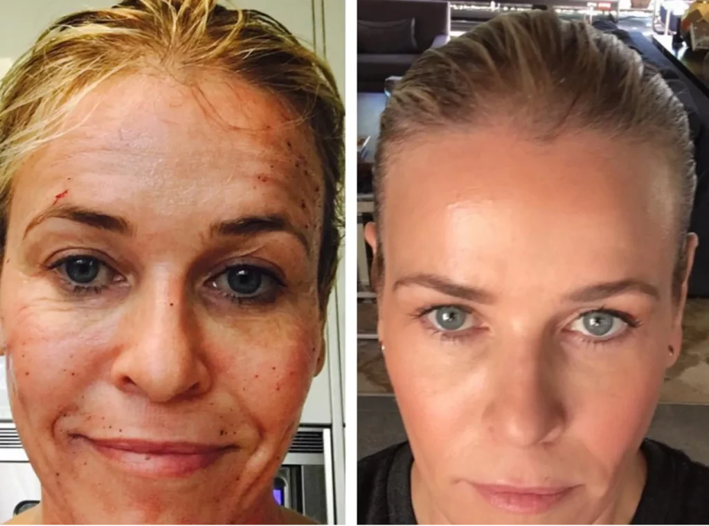 Chelsea Handler's Plastic Surgery: Did She Have Any Cosmetic Enhancements?