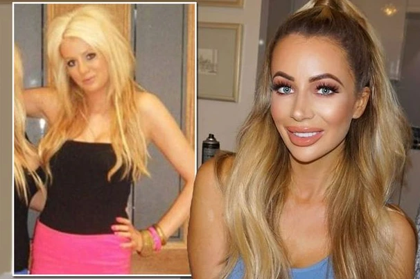 Olivia Attwood Before Surgery 2