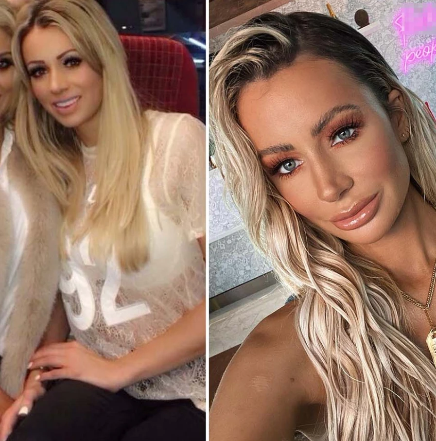 Olivia Attwood Before Surgery