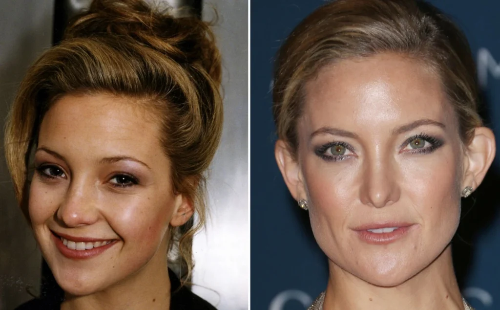Kate Hudson: A Star Who Shines with or without Plastic Surgery