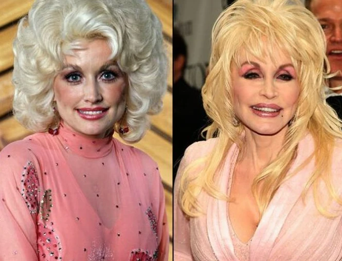 Dolly Parton Plastic Surgery 2