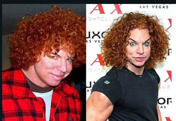Carrot Top Before Surgery